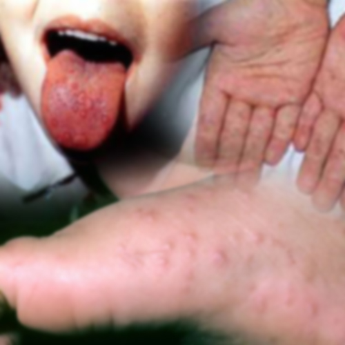 โรคมือ เท้า ปาก จากเชื้อเอนเทอโรไวรัส 71 เป็นอย่างไร